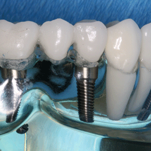 Dental Implant Model