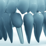 single tooth dental implant 