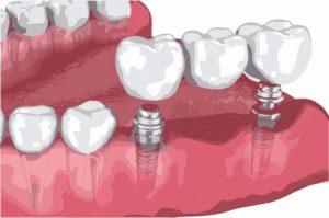 dental implant supported bridge
